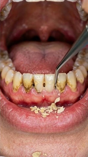 Maintain your smile by scheduling professional cleanings twice a year to prevent calculus buildup