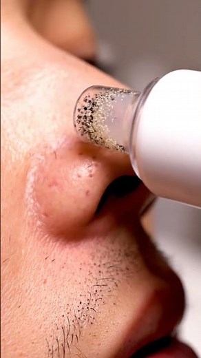 “Dermatologist-Style Vacuum Cleanup | Ultra Clear Extraction Shots”