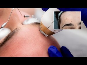 Scar Removal on Face with Fractional Laser