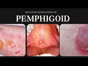Pemphigoid: Types, Causes, Clinical Presentation, Diagnosis, and Treatment