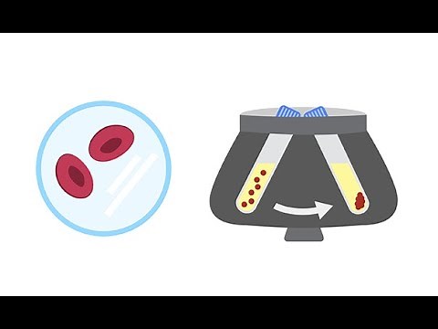 Microscopic examination of the urine sediment