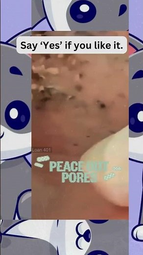 🔥Deep Blackheads, Milia & Whitehead Removal pimple popping New| Big Cystic Acne Extraction