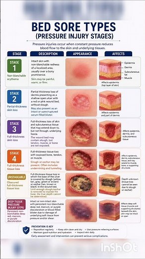 Bed sore types / Types of bed sore / Decubitus ulcer / Pressure sore /
