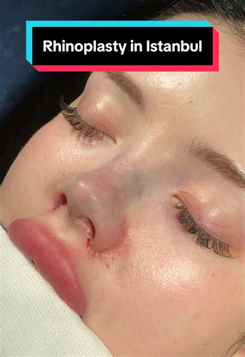 #rhinoplasty #nosejob #rhinoplastyturkey #barbienose #nosejobturkey | nose