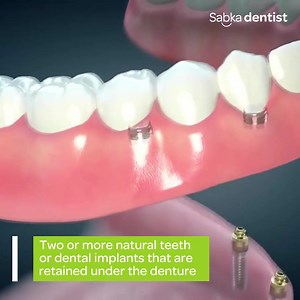 35 reactions | Overlay Dentures are prostheses that are supported...