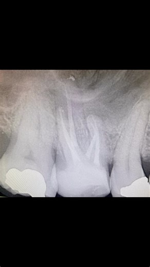 Restorability assessment - new composite core and orthograde root canal treatment in the maxillary right first molar. Protaper Gold, 3% hypo/penultimate 17% EDTA. Bioceramics, GIC seal GP and composite. MB2 prepared with F1 20/07. Cusps down ready for Modified Onlay Prep asap. | Performance Smiles