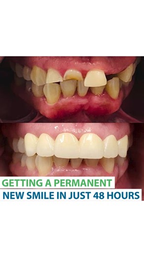 🇺🇸 Getting a permanent new smile in just 48 hours 🙌 At The Smile Mission we thrive to give you the best smile. We will take care of your oral health with our professional team to complete your smile! 😁 ✅ Free consultation ✅ The most affordable prices ✅ 10/10 Quality Our clients are happy with our service, so what are you waiting for? 😉 ▶️ Invest in your smile because you are going to be wearing it everyday! 🇪🇸 En The Smile Mission nos esforzamos por darte la mejor sonrisa. ¡Nos encargamos