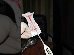 How to insert Mirena?