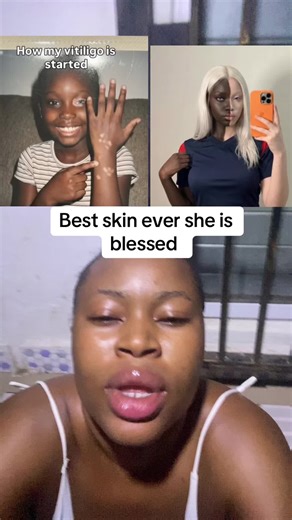 Understanding Vitiligo: A Personal Journey