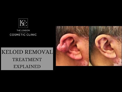 Keloid Removal Treatment Explained by Dr Salinda Johnson
