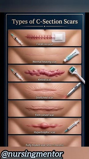 Types of C-Section Scars Explained | Cesarean Scar Healing Guide