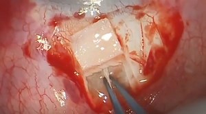 Glaucoma Intrascleral Tube Surgery - Eyetube