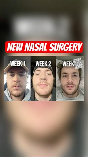 3 months after nasal surgery for sleep apnea (+update) #viral #youtuber #fyp #sleep #sleepapnea