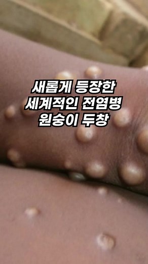 새로운 전염병, 원숭이두창 바이러스 #틱톡쌤 #틱톡교실 #에듀톡 #틱톡꿀팁 #틱톡백과 #원숭이두창
