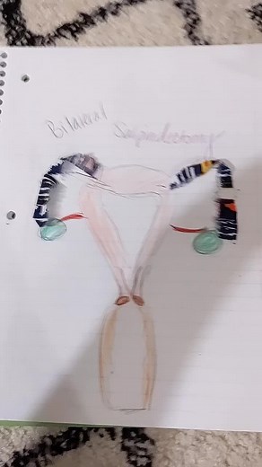 Understanding Bilateral Salpingectomy Procedure