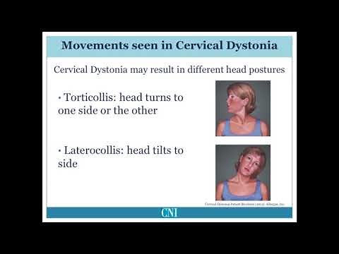 What is Cervical Dystonia?