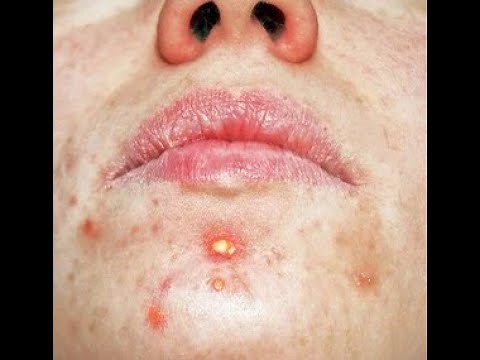 "Satisfying extraction of blackhead near the Lips: A Calming Skincare Experience"