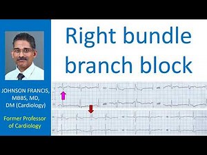 Right bundle branch block
