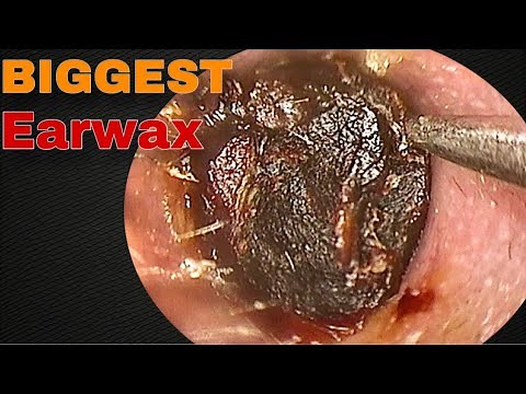 BIGGEST Earwax, Difficult Removal, EP 10 | Doctor Anh