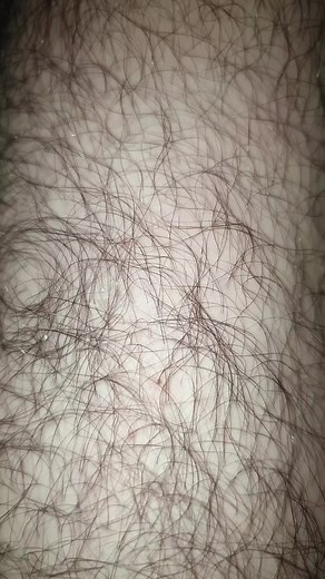 ingrown remove 115 على TikTok