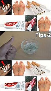 JUST 30 MINUTES | 2 Tips | How To Remove Foot Corn Or Callus At Home | MAGIC INGREDIENTS |