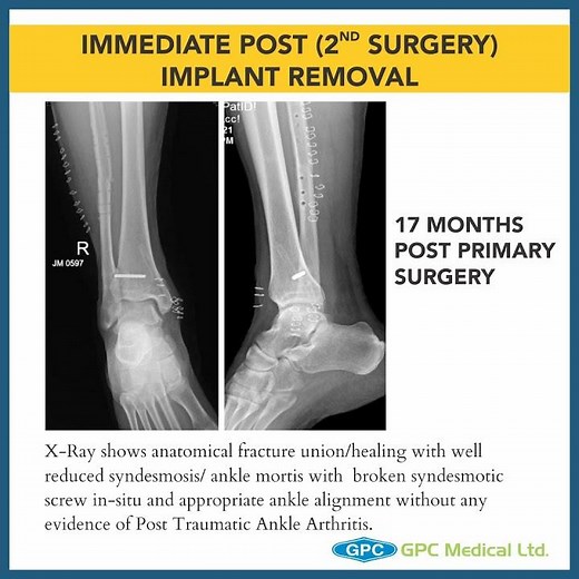 Ankle Fracture - Management Technique for Fracture Medial Malleolus with Posterior Malleolus