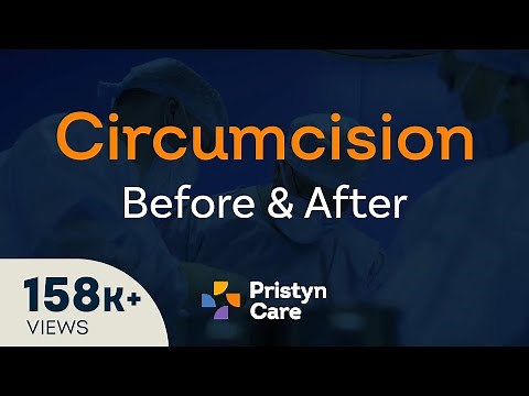 Before v/s After Laser Circumcision Surgery - For FREE Consultation Call On 08065417725