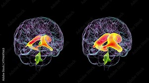 Animation showing enlarged lateral ventricles (hydrocephalus, right) compared to normal lateral ventricles (left) of the brain