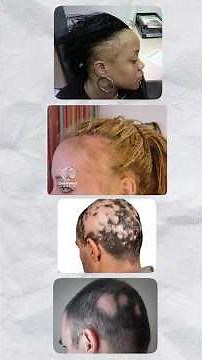 Do You Need To Use Minoxidil Forever!