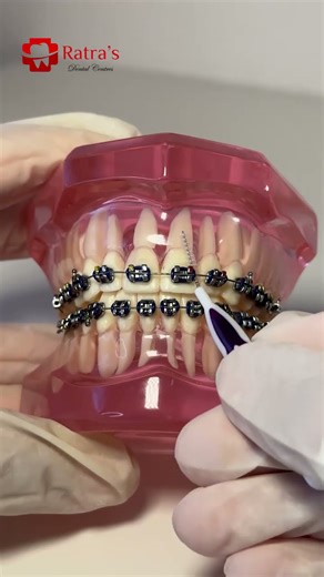Braces Cleaning Tips | How to Clean Teeth with Braces Properly 🪥 | Ratra Dental Noida