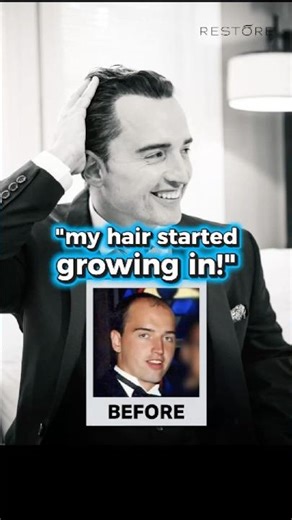 ⏱ How Long After a Hair Transplant Does Hair Start Growing?