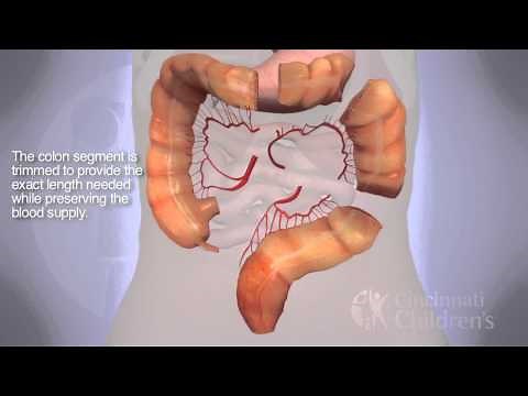 Segmental Colonic Interposition for Esophageal Atresia: 3D Animation