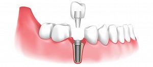 Replacing the Missing Teeth with the Dental Implants