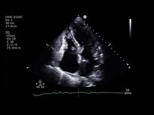 Apical 4 Chamber View Showing Tricuspid Valve Vegetation