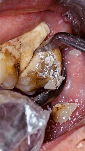 How to remove plaque and tartar from teeth#viral