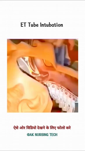 4.5K views · 61 reactions | ғᴏʟʟᴏᴡ -@ak_nursing_tech _tech ᴀ ᴅʀᴇᴀᴍ...