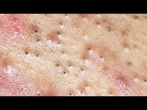 Squeezing Blackheads on the Face