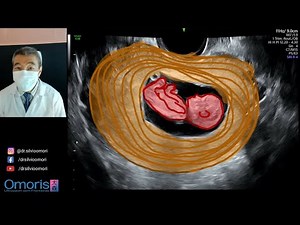 BLEEDING in the first trimester. Pregnancy 10 weeks. 3D 4D images.