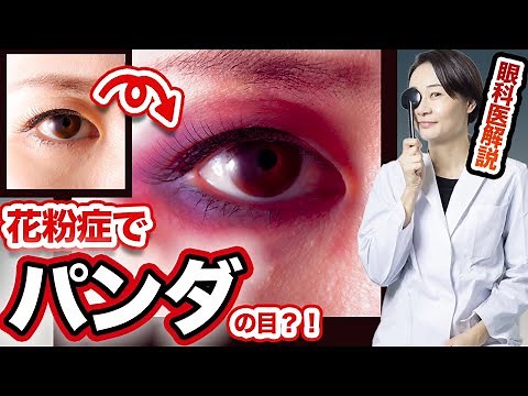 目がパンダになる？！花粉症の目の痒み・腫れ対策4つ眼科医が解説