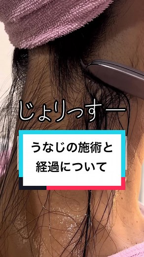 うなじの施術と形についてのガイド