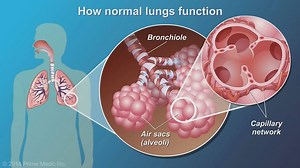 20K views · 150 reactions | This animation describes the causes, risk factors and common symptoms of chronic obstructive pulmonary disease (COPD), as well as how lungs with COPD function. Video Credit: Animated COPD Patient | COPD Awareness | Facebook