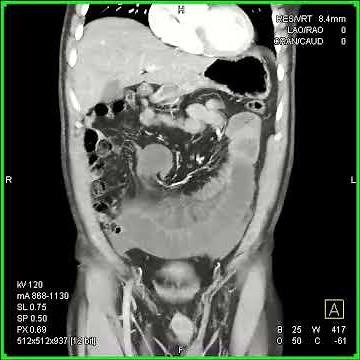 Midgut volvulus coronal