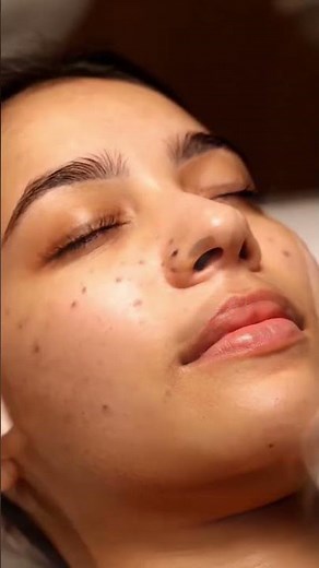 POV Facial: Realistic Whitehead Extraction on Nose & Soothing Gel Treatment | Calming ASMR #relax