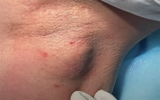 Juicy Underarm Cyst Drainage
