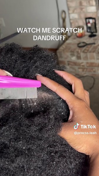 Effective Dandruff Removal Techniques for a Healthy Scalp