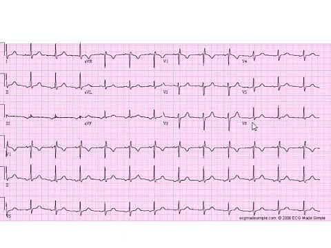 Stepwise Interpretation 4: Ectopic Atrial Rhythm