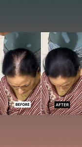 6.2M views · 13K reactions | Quickest and easiest hair thinning hack using @onehairstopindia fill me in hair powder 懶 | 1 Hair Stop India | Facebook