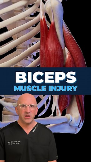 Cory Calendine MD on Instagram: "💪🏼 “Popeye” arm? . This eye-catching biceps muscle deformity occurs when the the biceps tendon tears, causing the muscle to bunch up and form a prominent bulge in the upper arm. It often starts with a POP! during heavy lifting or intense overhead activity. Unlike Popeye’s instant spinach-fueled muscle growth, this deformity isn’t a sign of strength – it’s an injury that needs attention . Who’s at risk? Biceps injuries are more common in: • People >50 #BicepsTea