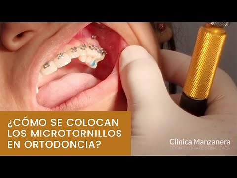 ¿Cómo se colocan los microtornillos en ortodoncia?