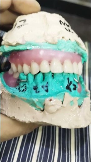Upper Lower Acrylic Removable Partial Denture Ready For Flasking 😁😁😁#rpddentalprocedure#viralvideo